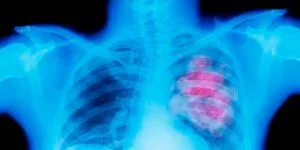 El ozono y su relación con el cáncer
